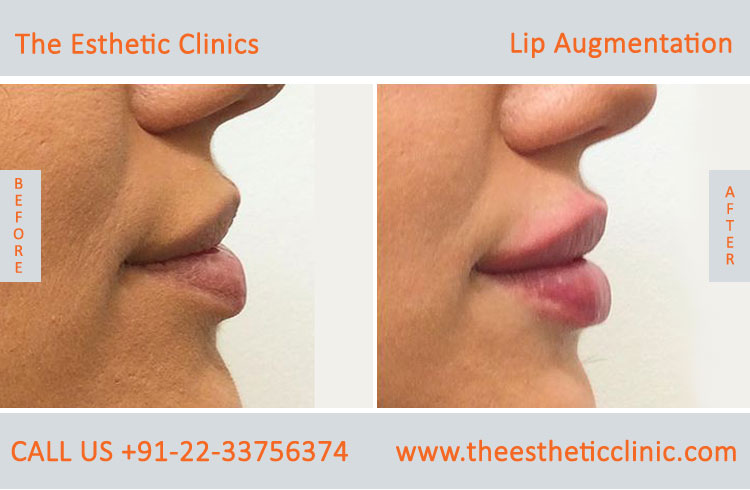 Lip Augmentation, Lip Enlargement, Lip Implant Surgery before after photos in mumbai india (5)